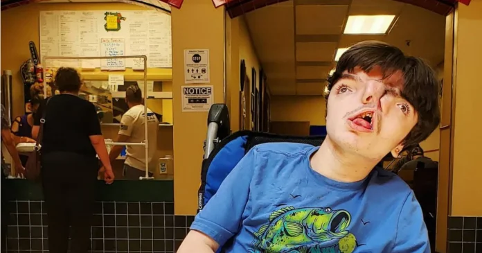 Boy with two faces celebrates 18th birthday, doctors say it is difficult to survive

