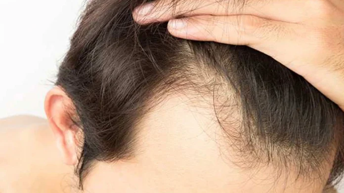 Hair Fall In Men: ...तर तुमचीही केस गळती थांबू शकेल, फक्त या गोष्टी पाळा  