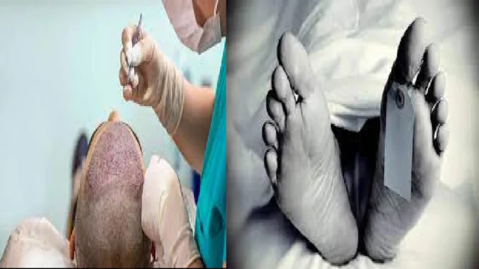 हेयर ट्रान्सप्लांट करताय तर सावधान! हेअर ट्रान्सप्लांट केल्याने मृत्यू...